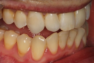 Custom shade matching for high quality aesthetic dentistry